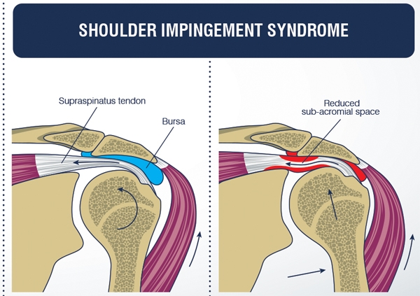 사진 왼쪽: 정상 어깨, 오른쪽: 어깨 충돌 증후군 / 출처: 구글