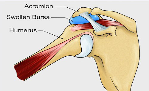 사진 파란색으로 표시된 어깨관절 활액낭/ 출처: 구글